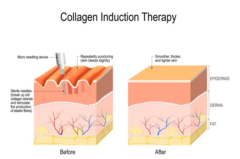 Corrective Needling
