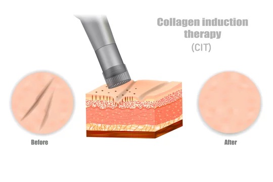 collagen induction therapy_dry tattooing_microneedling